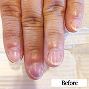 弱い爪（欠ける・折れる）