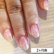 弱い爪（欠ける・折れる）