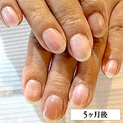 弱い爪（欠ける・折れる）